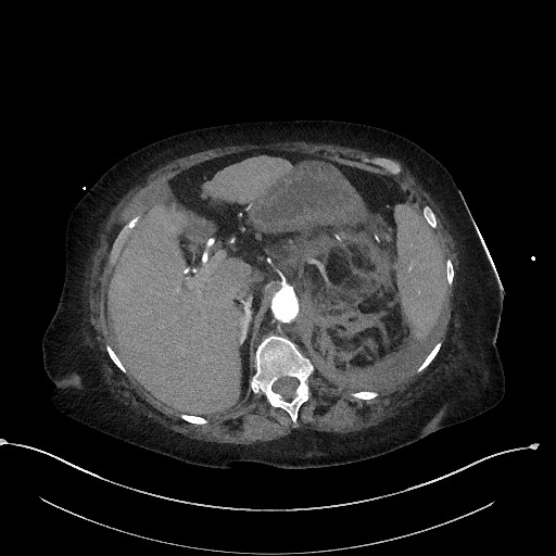 Active renal extravasation with large subcapsular and retroperitoneal hemorrhage (Radiopaedia 60975-68796 Axial C+ arterial phase 53).jpg