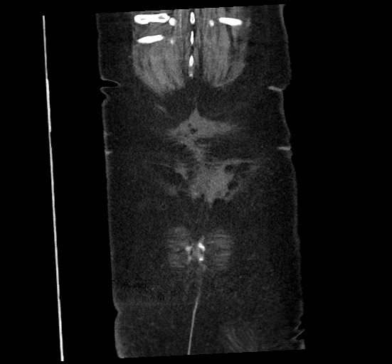 Active renal extravasation with large subcapsular and retroperitoneal hemorrhage (Radiopaedia 60975-68796 Coronal C+ portal venous phase 142).jpg
