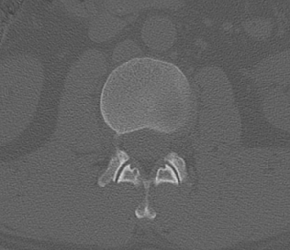File:Acute L1 burst compression fracture (Radiopaedia 34430-35755 Axial bone window 30).png
