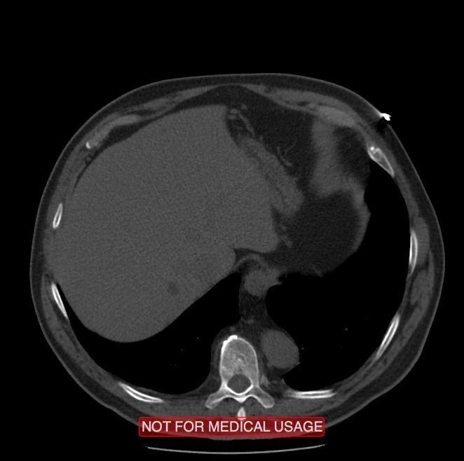 Acute aortic dissection - Stanford type A (Radiopaedia 40661-43285 Axial non-contrast 62).jpg