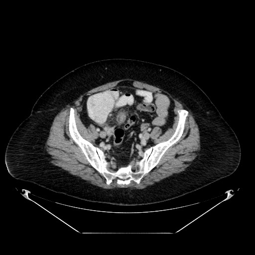 Acute appendicitis, heterotaxy syndrome (Radiopaedia 66884-76202 Axial C+ portal venous phase 102).jpg