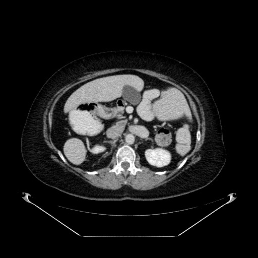 Acute appendicitis, heterotaxy syndrome (Radiopaedia 66884-76202 Axial C+ portal venous phase 44).jpg