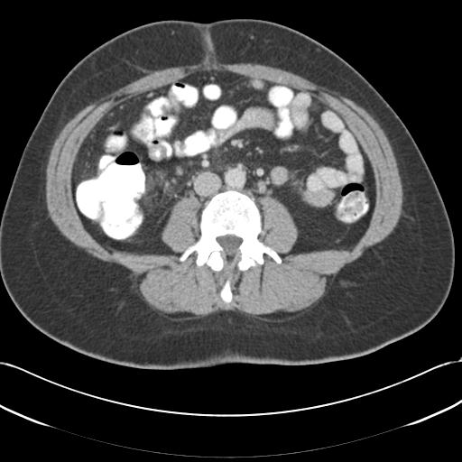 Acute appendicitis (Radiopaedia 30297-30934 Axial C+ portal venous phase 44).jpg