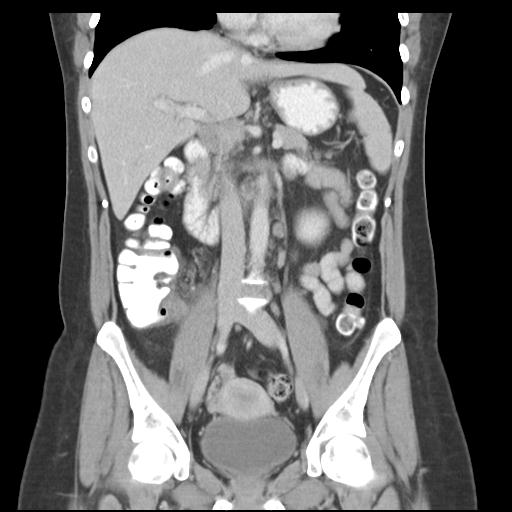 Acute appendicitis (Radiopaedia 30297-30934 Coronal C+ portal venous phase 23).jpg