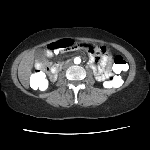 File:Acute appendicitis (Radiopaedia 52672-58589 Axial C+ arterial phase 1).jpg