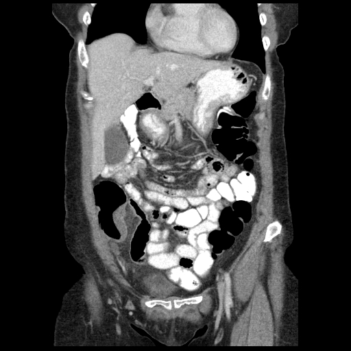 Acute appendicitis (Radiopaedia 52672-58589 Coronal C+ portal venous phase 18).jpg