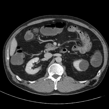 Acute appendicitis (Radiopaedia 66513-75790 Axial C+ portal venous phase 24).jpg