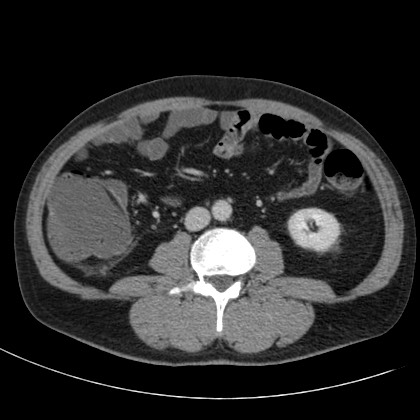 Acute appendicitis (Radiopaedia 66513-75790 Axial C+ portal venous phase 43).jpg