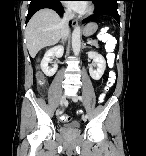 Acute appendicitis (Radiopaedia 77016-88960 Coronal C+ portal venous phase 57).jpg