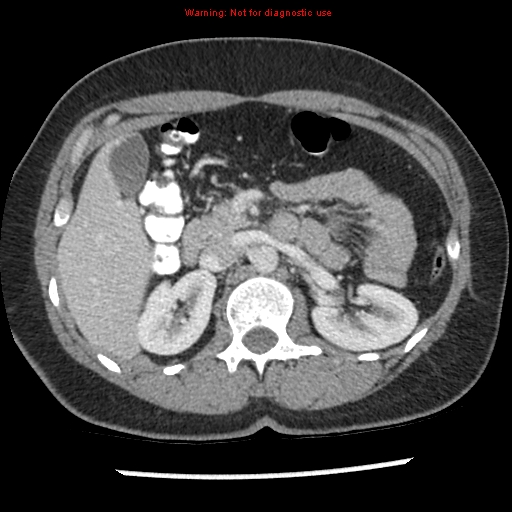 File:Acute appendicitis (Radiopaedia 7966-8812 C+ portal venous phase 12).jpg