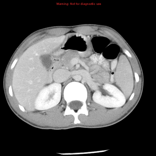 Acute appendicitis (Radiopaedia 8195-9045 Axial C+ portal venous phase 24).jpg