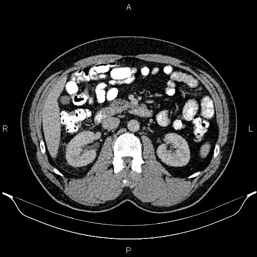 Acute appendicitis (Radiopaedia 84780-100240 Axial C+ portal venous phase 44).jpg