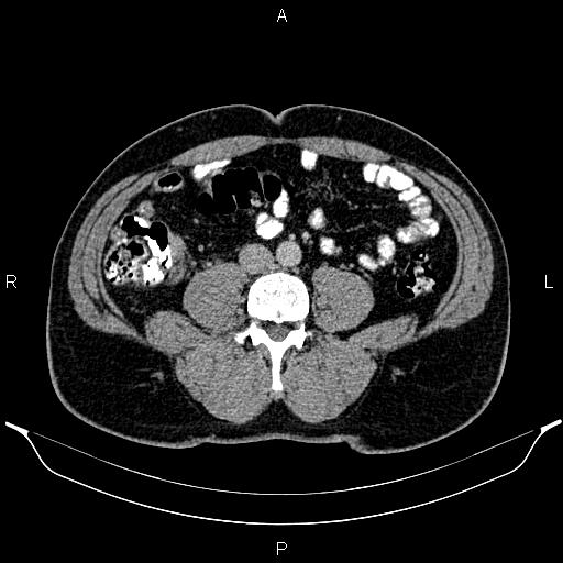 Acute appendicitis (Radiopaedia 84780-100240 Axial C+ portal venous phase 65).jpg