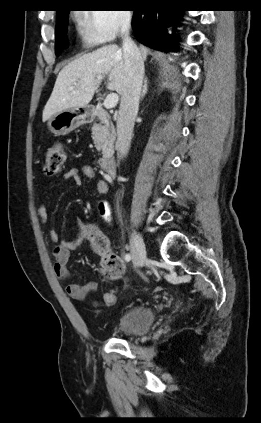 Acute appendicitis - large appendicoliths (Radiopaedia 61805-69820 Sagittal C+ portal venous phase 68).jpg