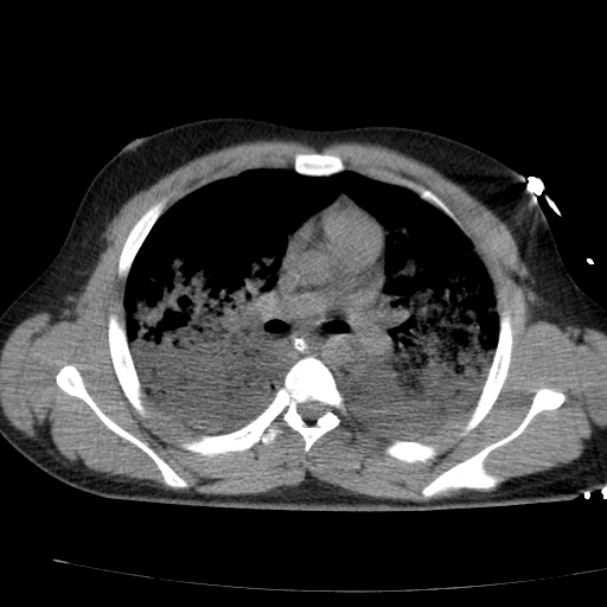 Acute aspiration pneumonitis (Radiopaedia 33605-34703 Axial non-contrast 42).jpg