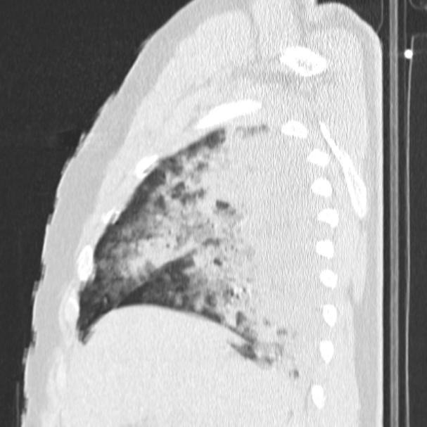 Acute aspiration pneumonitis (Radiopaedia 33605-34703 Sagittal lung window 23).jpg