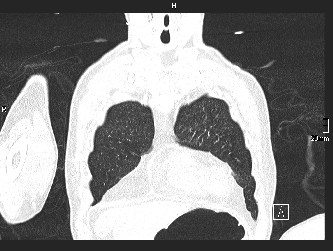 Acute aspiration pneumonitis (Radiopaedia 55642-62166 Coronal lung window 16).jpg