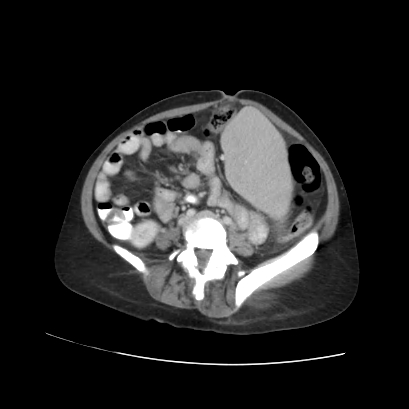 Acute calculous cholecystitis in patient with osteopetrosis (Radiopaedia 77871-90159 Axial C+ portal venous phase 54).jpg