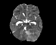 File:Acute cerebellar ataxia (Radiopaedia 61487-69446 Axial ADC 7).jpg