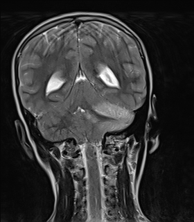 File:Acute cerebellar ataxia (Radiopaedia 61487-69446 Coronal T2 11).jpg