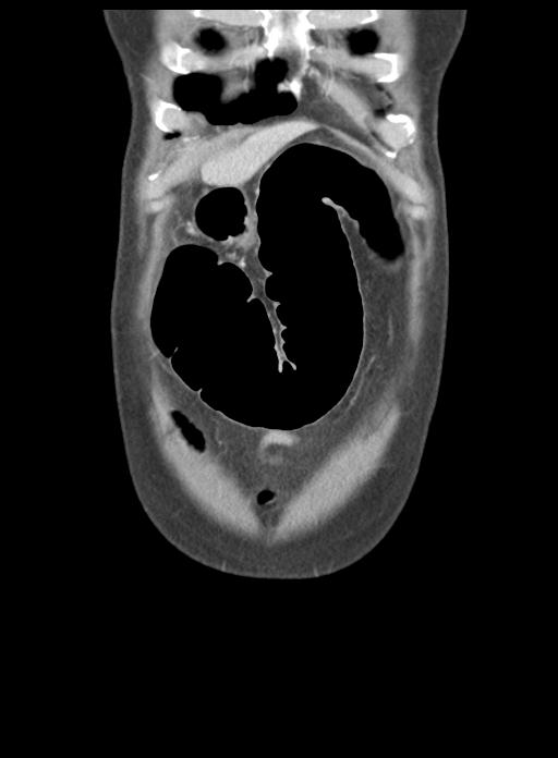 Acute cholecystitis (Radiopaedia 29814-30327 Coronal C+ portal venous phase 9).jpg