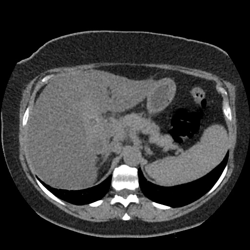 Acute cholecystitis and ureteric colic (Radiopaedia 42330-45444 Axial prone 17).jpg