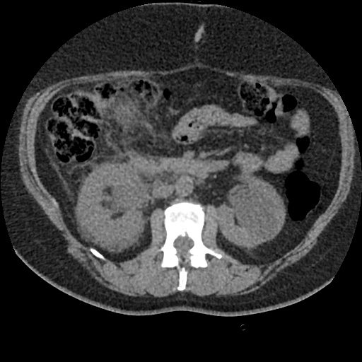 File:Acute cholecystitis and ureteric colic (Radiopaedia 42330-45444 Axial prone 40).jpg