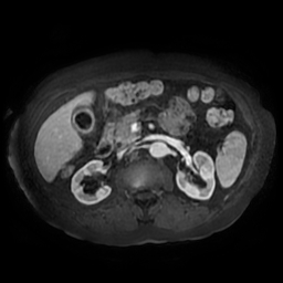 Acute cholecystitis complicated by pylephlebitis (Radiopaedia 65782-74915 Axial arterioportal phase T1 C+ fat sat 75).jpg