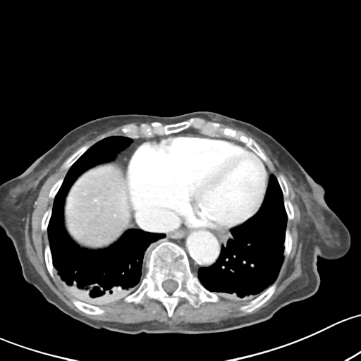 Acute cholecystitis with contained perforation (Radiopaedia 47328-51907 Axial C+ portal venous phase 5).png