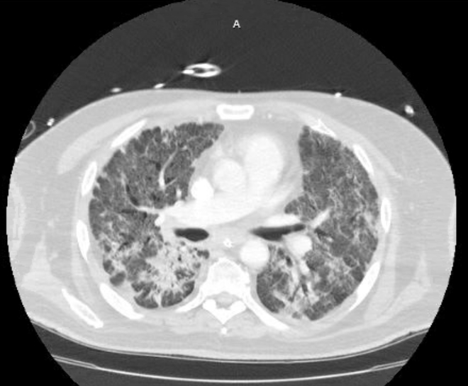 Acute cor pulmonale (ultrasound) (Radiopaedia 83508-98818 Axial lung window 43).jpg