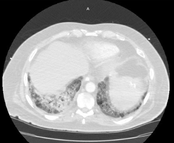 Acute cor pulmonale (ultrasound) (Radiopaedia 83508-98818 Axial lung window 70).jpg