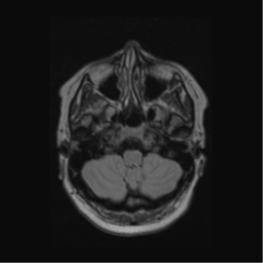 Acute disseminated encephalomyelitis (ADEM) (Radiopaedia 38073-40065 Axial FLAIR 9).png
