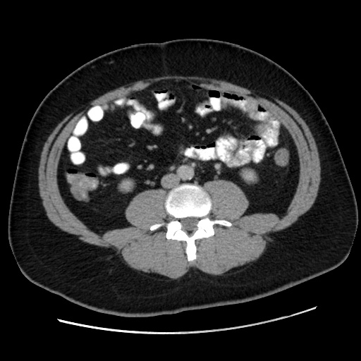 Acute diverticulitis with localized perforation (Radiopaedia 41296-44113 Axial C+ portal venous phase 51).jpg