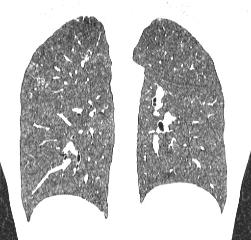 Acute hypersensitivity pneumonitis (Radiopaedia 85293-100870 Coronal lung window 91).jpg
