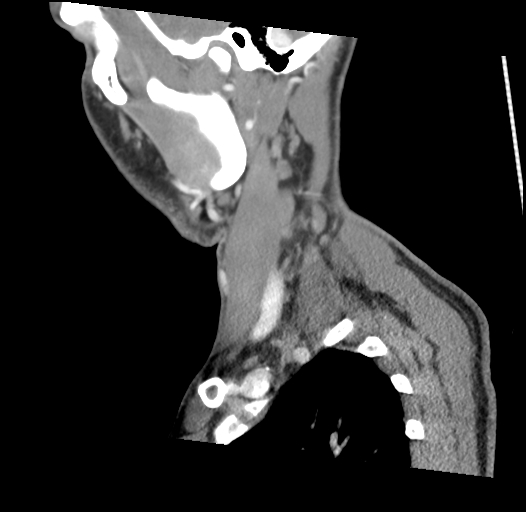 Acute longus colli calcific tendinitis (Radiopaedia 72495-83036 Sagittal C+ arterial phase 55).jpg