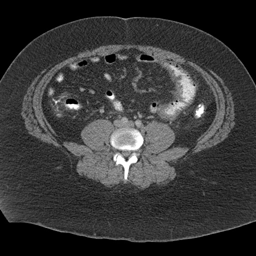 Acute mesenteric venous ischemia (Radiopaedia 46041-50383 Axial C+ portal venous phase 82).jpg