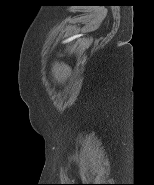 Acute mesenteric venous ischemia (Radiopaedia 46041-50383 Sagittal C+ portal venous phase 5).jpg
