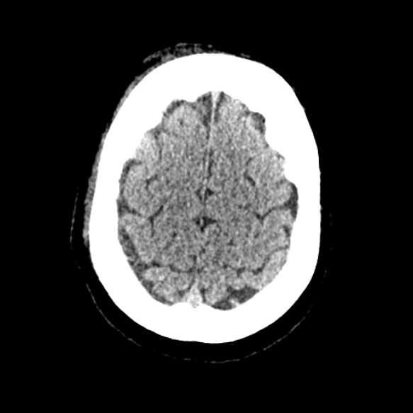 Acute middle cerebral artery territory infarct (Radiopaedia 52380-58283 Axial non-contrast 90).jpg