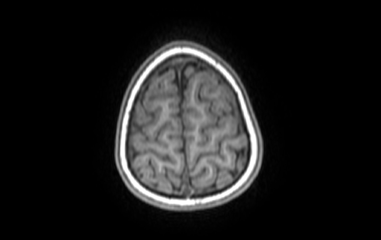 File:Acute necrotizing encephalitis of childhood (Radiopaedia 67356-76737 Axial T1 10).jpg