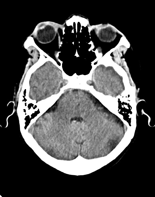 Acute on chronic subdural hematoma (Radiopaedia 74814-85823 Axial non-contrast 34).jpg
