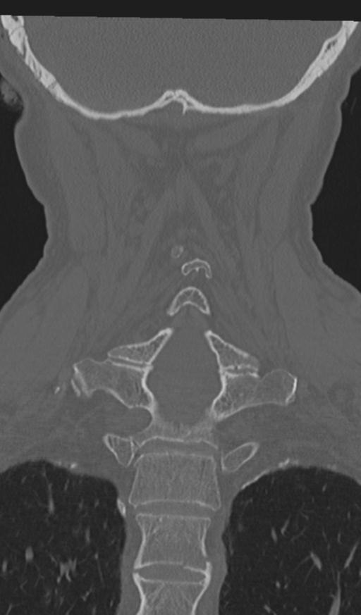 Acute on chronic subdural hematoma and thoracic vertebral injury in a multitrauma patient (Radiopaedia 31698-32619 Coronal bone window 45).jpg