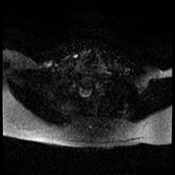 Acute otitis externa (Radiopaedia 57296-64236 Axial DWI 59).jpg