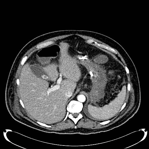 Acute pancreatic necrosis (Radiopaedia 13560-18500 Axial C+ portal venous phase 37).jpg