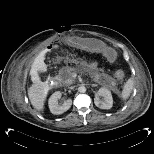 File:Acute pancreatic necrosis (Radiopaedia 13560-18503 Axial C+ portal venous phase 29).jpg