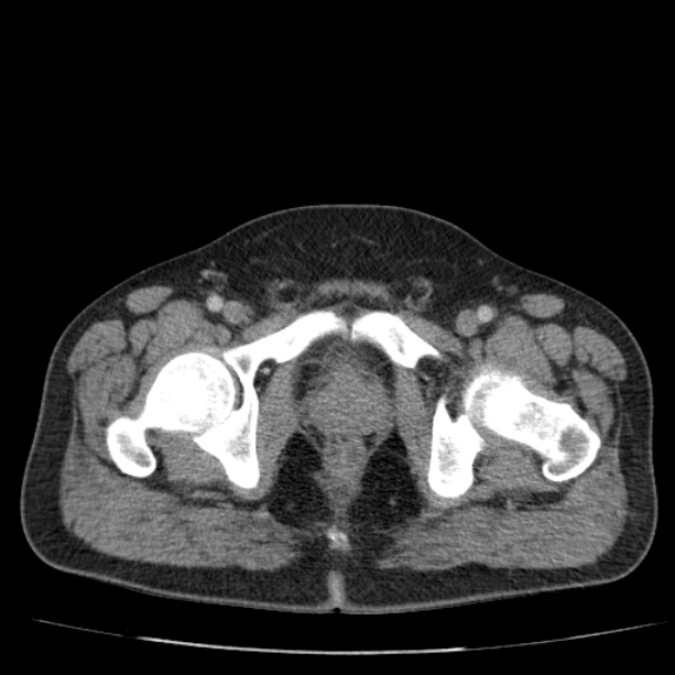 Acute pancreatitis (Radiopaedia 26663-26813 Axial C+ portal venous phase 86).jpg