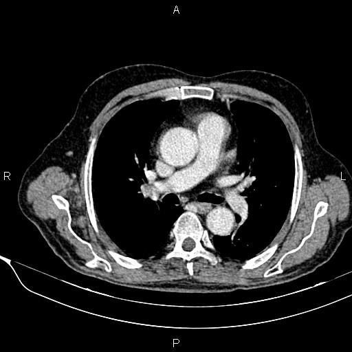 File:Acute pancreatitis (Radiopaedia 85146-100701 Axial C+ portal venous phase 3).jpg