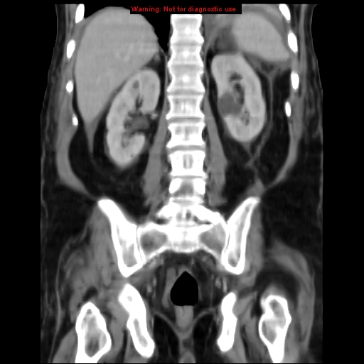 Acute pancreatitis with incidental pancreatic lipoma (Radiopaedia 10190-10730 Coronal C+ portal venous phase 53).jpg