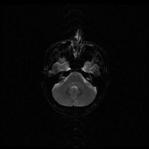 File:Acute pontine infarct from vertebral artery dissection (Radiopaedia 34111-35370 Axial Echo planar 4).png