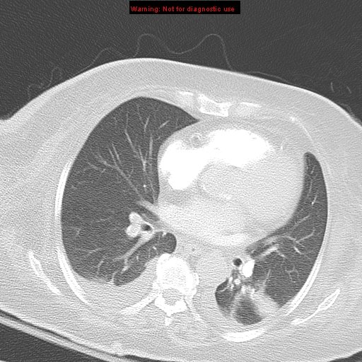 File:Acute pulmonary embolism (Radiopaedia 13286-13289 B 23).jpg