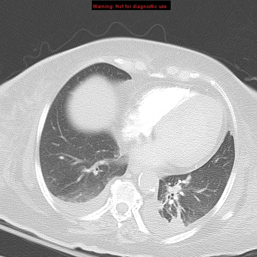 File:Acute pulmonary embolism (Radiopaedia 13286-13289 B 28).jpg